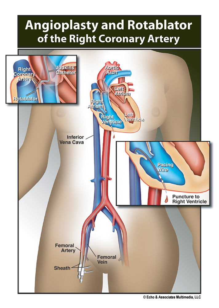 Right Coronary Artery
